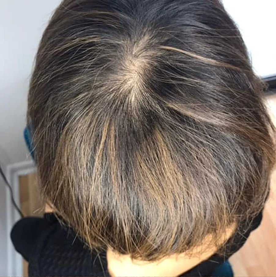 Thinning crown · Women — before