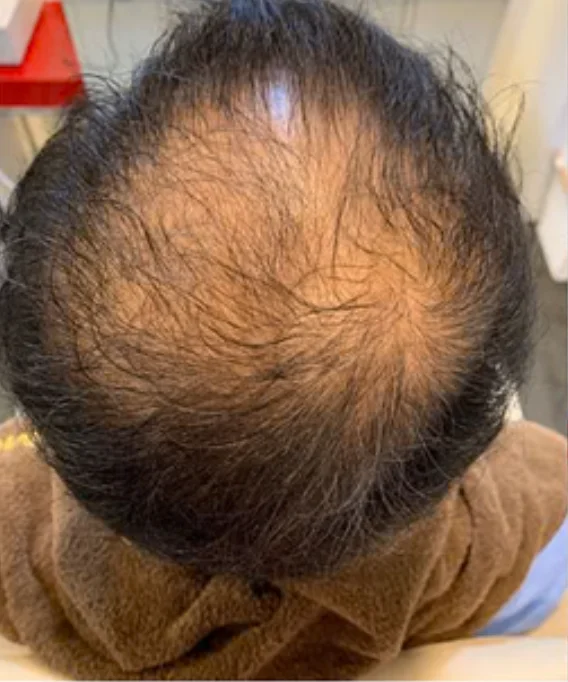 Crown hair loss · Men — before