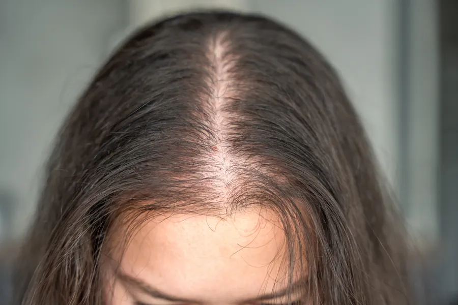 Visibly thinning hair part